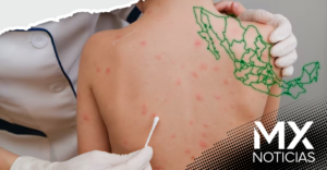 México registra 362 casos de sarampión, la mayoría en Chihuahua