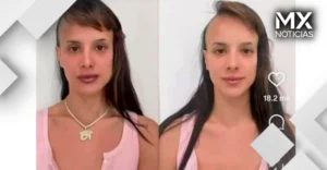 Gala Montes se somete a tratamiento estético en la cara; comparte su antes y su después
