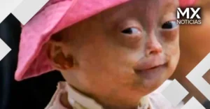 Muere Elis Lima Carneiro a los 5 años, la niña que enfrentaba un raro síndrome de envejecimiento