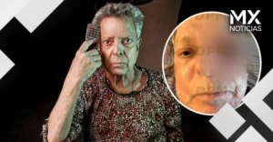 César Bono pierde su ojo tras detectarle tumor; éste es el estado de salud del actor
